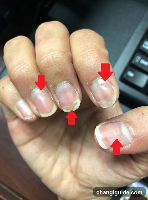 Hand with Nail Issues